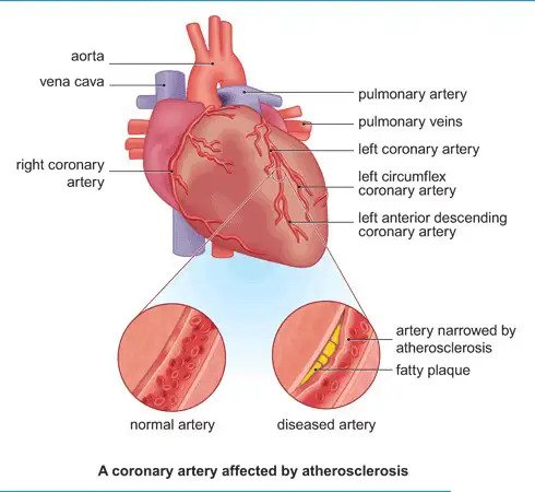 โรคหลอดเลือดหัวใจ HEART DISEASE