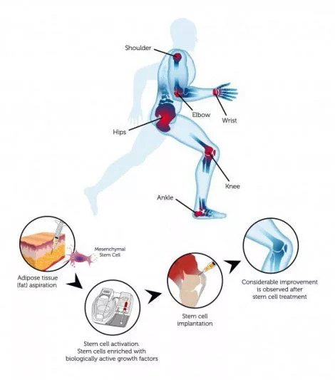 โรคหลอดเลือดหัวใจ HEART DISEASE